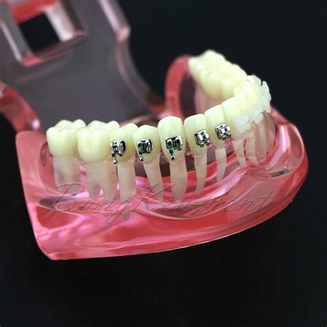 Buy Orthodontic Dental Model Typodont Metal Ceramic Brackets Braces ...