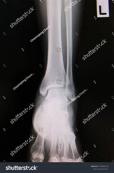 X Ray Ankle Ap Foot, Ankle, And Calf | Radiology Key