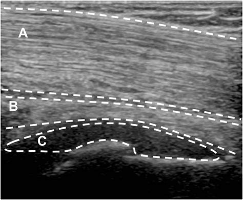Ultrasound-Guided Iliopsoas Bursal Injections for Management of Iliopsoas Bursitis After Total ...