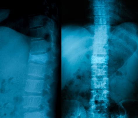 Image result for Inversion Table for Bulging Disc