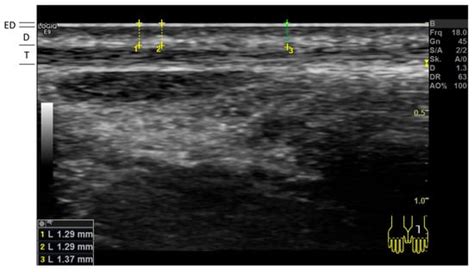 HF-Ultrasonography to Quantify Skin Atrophy in Patients with ...
