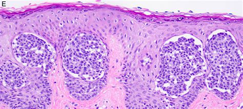 Pathology Outlines - Special site nevus