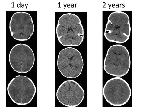 Image result for Normal Brain CT Scan