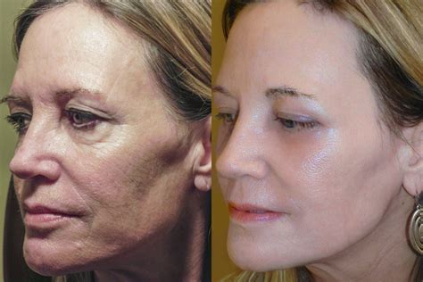 Laser cosmetic surgeon details 3 ways to reverse damage to the skin ...