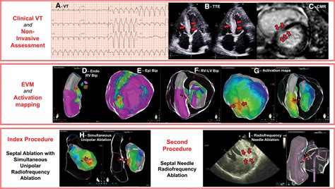 Substrate Characterization and Outcomes of Ventricular Tachycardia ...