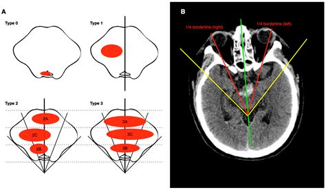 ZJUSAH Classification: A New Classification for Primary Brainstem Hemorrhage - hemorrhage in pons