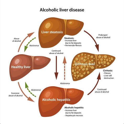 Liver Cirrhosis Alcohol