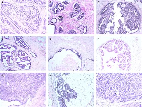 A retrospective observational study of intraductal breast papilloma and its coexisting lesions ...