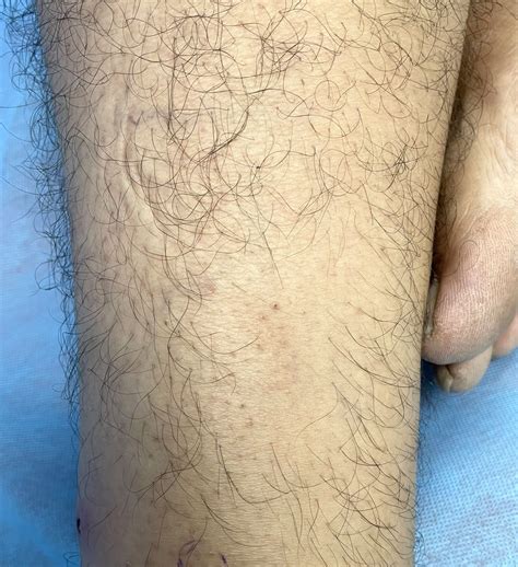 Patchy hair loss over the leg: a case of primary follicular mucinosis ...