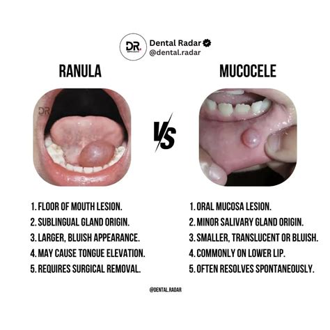 DentalRadar | Boneloss caused by tongue piercing | Instagram