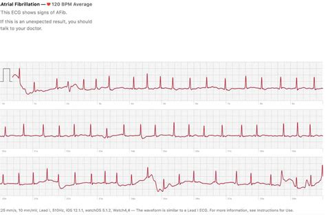 Apple Watch ECG心电图不确定什么意思，是心跳不正常吗？ - iwatch心电图 - 实验室设备网