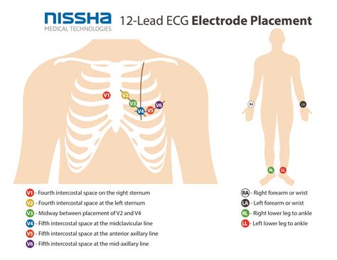 Printable ECG Electrode Placement Guide - Nissha 360