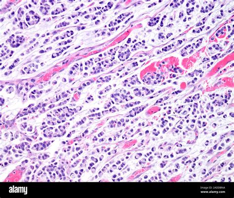 Signet ring cell carcinoma of the colon, light micrograph. This is a rare form of adenocarcinoma ...