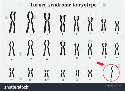 Turner Syndrome Chromosomes