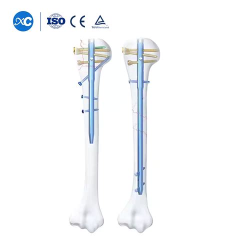 Multi-Lock Humerus Intramedullary Nail - XC Medico