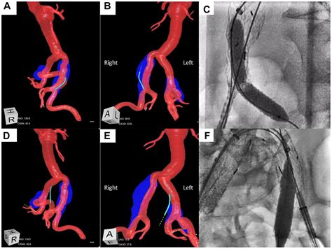 Endovascular repair of bilateral common iliac artery aneurysms using ...