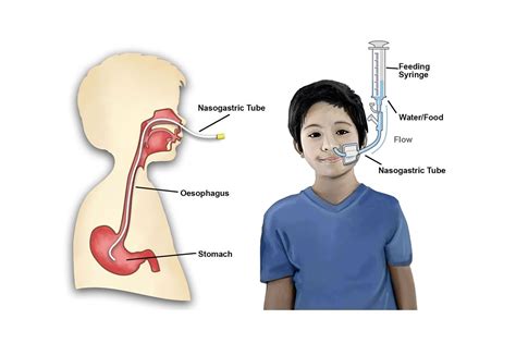 Nasogastric (NG) Tubes