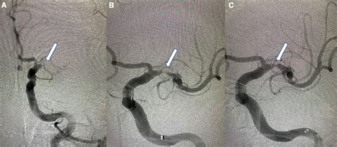 Emergent Large Vessel Occlusion due to Intracranial Stenosis: Identification, Management ...