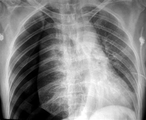 Tension Pneumothorax X Ray