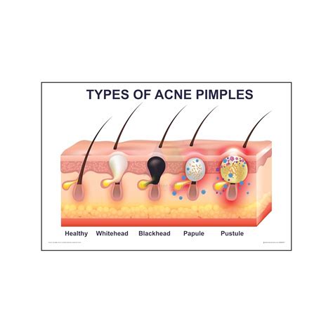 Anne Print Solutions® Lyme Disease Symptoms Posters Without Frame ...