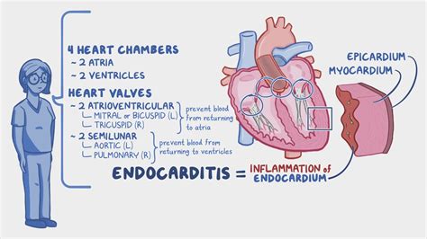 Endocarditis