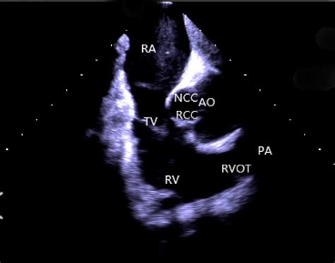 Frontiers | Understanding the scope of intracardiac echocardiography in ...