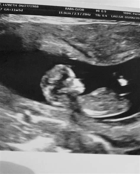Baby boy ultrasound at 12 weeks pregnant | Boy ultrasound, 12 weeks pregnant, Baby ultrasound ...