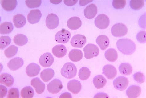 Plasmodium Blood Smear at Michael Nipper blog