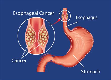Esophagus Cancer Diagram