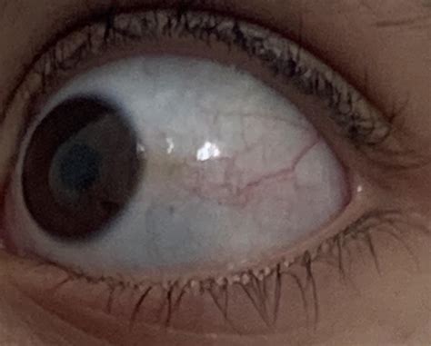 Gray Spot In Your Eye: What It Could Mean, 51% OFF - black spot white of eye