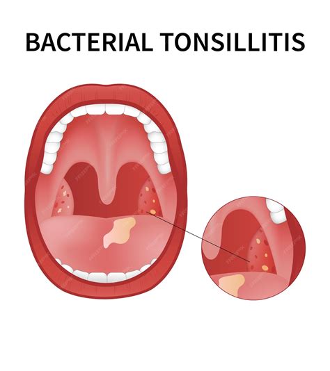 Bacterial Vs Viral Tonsillitis