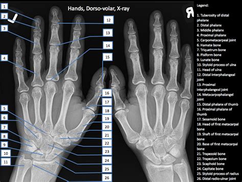 Image result for High-Resolution Hand MRI