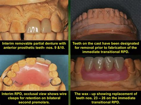 Indication of Alternative removable partial dentures | PPTX