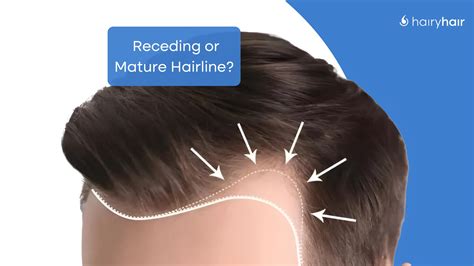 Mature Hairline vs Receding Hairline: What's the Difference? - Hairy Hair