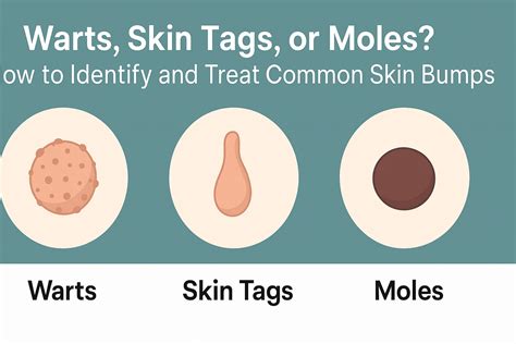 Genital Wart Vs Skin Tag