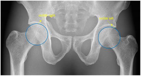 Hip Joint Xray