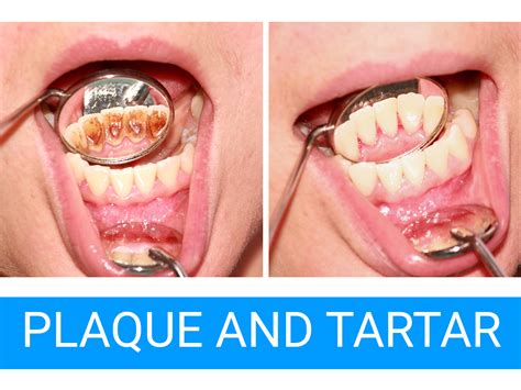 Causes Of Black Plaque On Teeth at Jasper Gunson blog