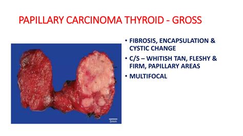 Papillary Carcinoma thyroid cytology.pptx