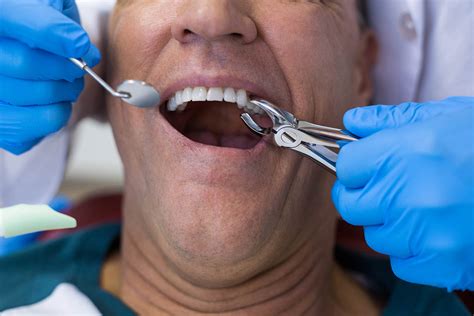 Tooth Extraction 的图像结果