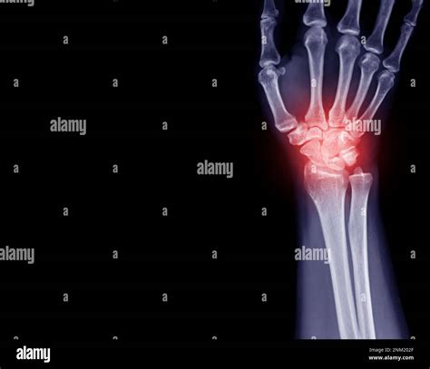 Normal Wrist X Ray