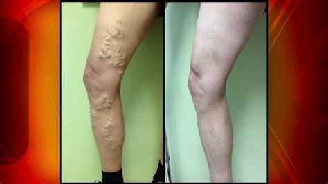 The Signs And Symptoms Of A DVT: Homans’ Sign | Daystar Properties