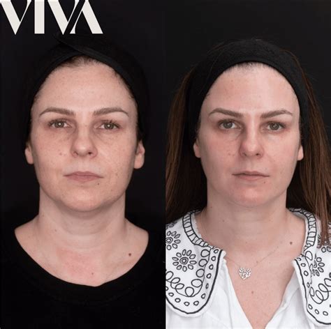 Fillers for jowls: Can cheek filler lift sagging jowls? - VIVA Skin Clinics