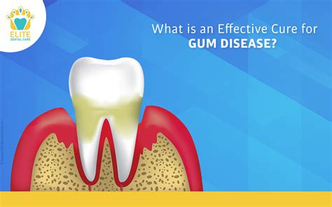 What is an Effective Cure for Gum Disease? - Elite Dental Care
