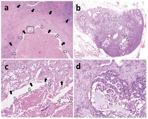 Fibrosis or Necrosis in Resected Lymph Node Indicate Metastasis Before ...