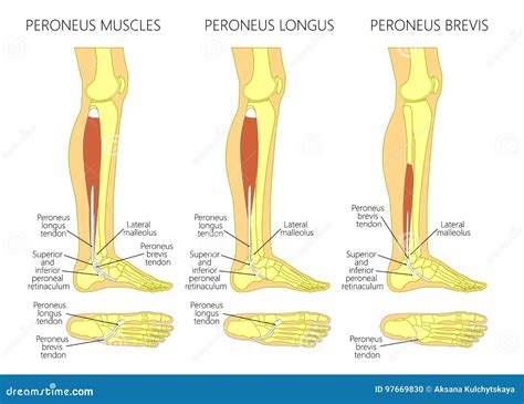 Peroneal Tendon Injuries_Rupture Of The Peroneus Longus Tendon Vector ...