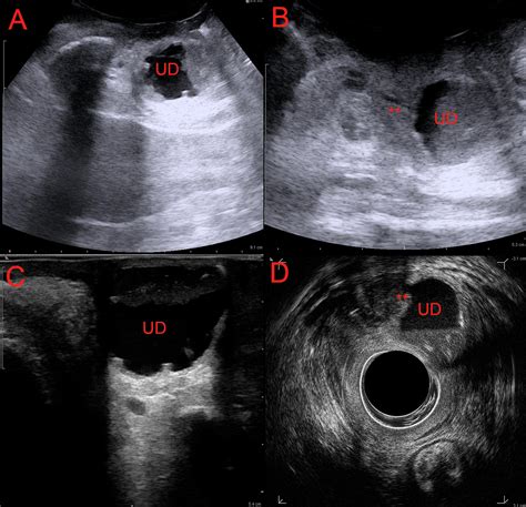 Transvaginal excision of urethral diverticulum: A video case report - European Journal of ...