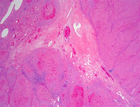Histologia De Hiperplasia Nodular Focal