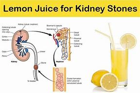 Image result for Potassium Citrate Kidney Stones