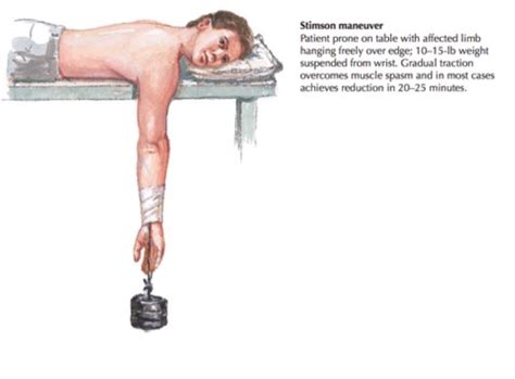 Image result for Shoulder Reduction Methods