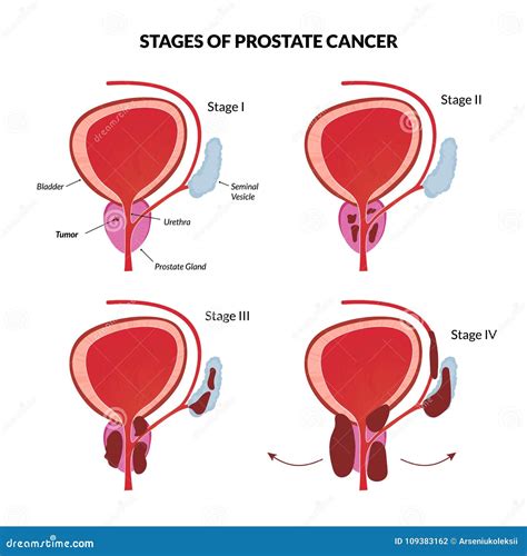 Prostate Cancer 的图像结果